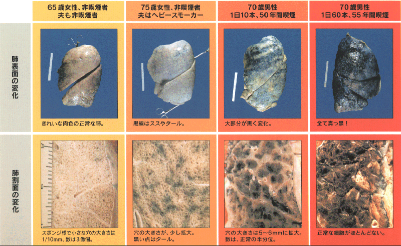 喫煙者におこる肺の変化